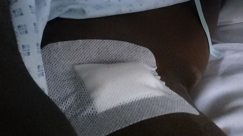 Stenlija Ibes kāja pēc operācijas